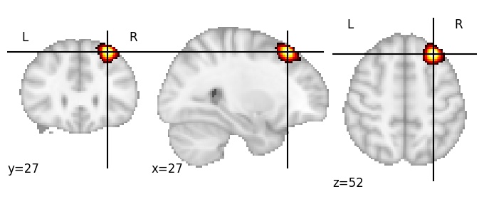 Component 11: Middle frontal gyrus superior RH