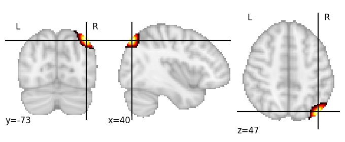 Component 101: Lateral occipital cortex superior RH