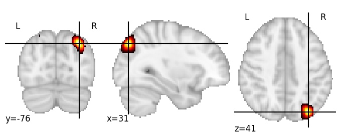 Component 192: Lateral occipital cortex postero-superior RH