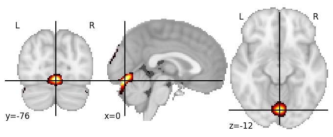 Component 248: Fluid between cerebellum and occipital cortex