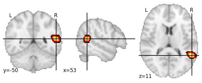 Component 259: Middle temporal gyrus postero-superior RH