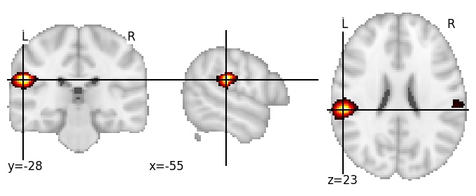 Component 279: Supramarginal gyrus antero-inferior LH