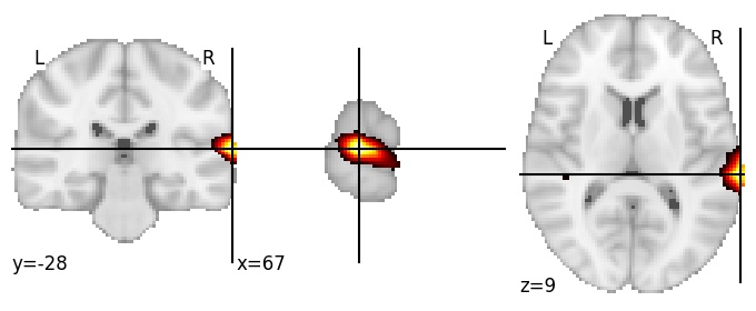Component 285: Superior temporal gyrus middle RH