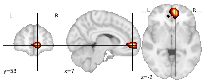 Component 289: Ventromedial prefrontal cortex posterior RH