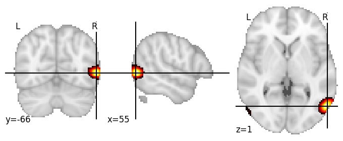 Component 31: Lateral occipital cortex anterior RH