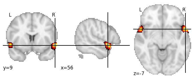 Component 311: Superior temporal gyrus anterior