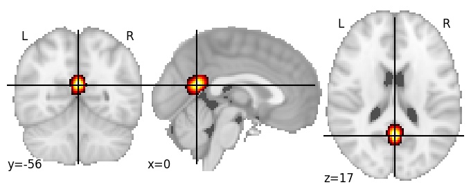 Component 390: Posterior cingulate cortex postero-inferior