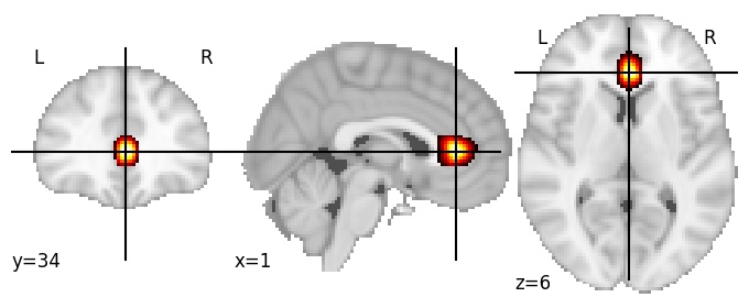 Component 393: Anterior cingulate cortex inferior