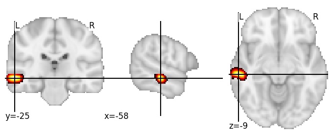 Component 397: Middle temporal gyrus middle posterior LH
