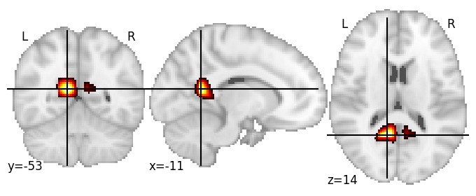 Component 407: Posterior cingulate cortex inferior LH