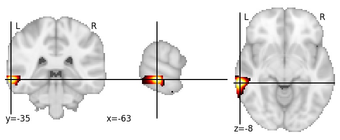 Component 421: Middle temporal gyrus middle inferior LH