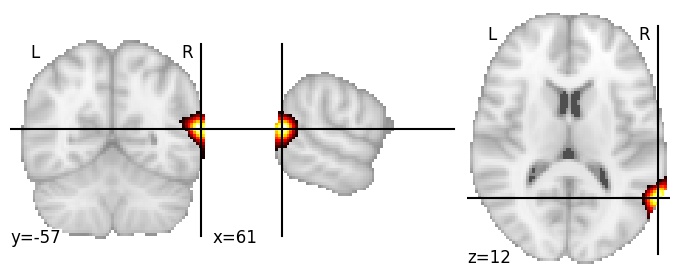 Component 433: Angular gyrus postero-inferior RH