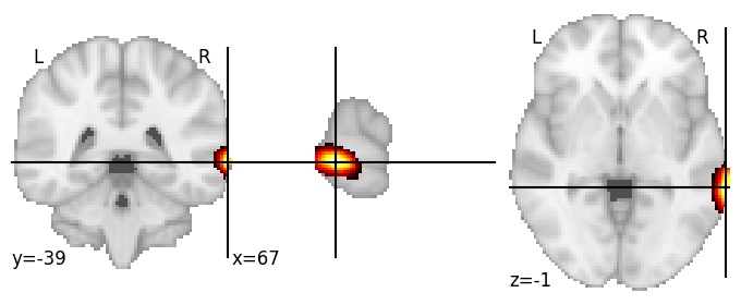 Component 532: Inferior temporal gyrus middle RH