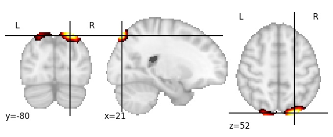 Component 612: Superior occipital gyrus superior