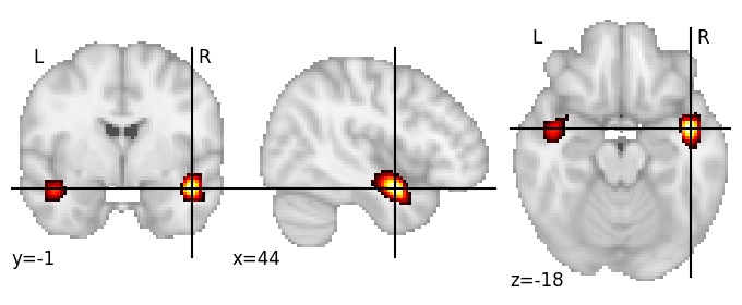 Component 614: Superior temporal gyrus anterior medial