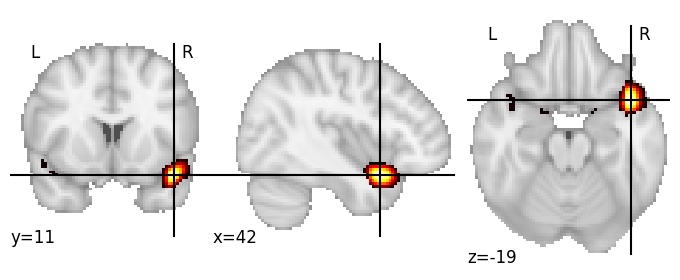 Component 648: Superior temporal gyrus anterior medial RH