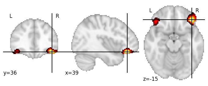 Component 693: Lateral orbital gyrus anterior