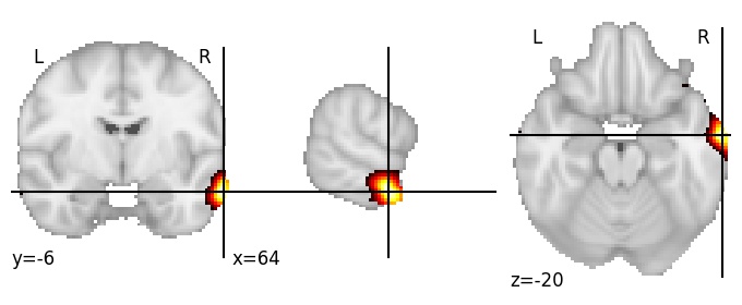 Component 720: Middle temporal gyrus anterior RH