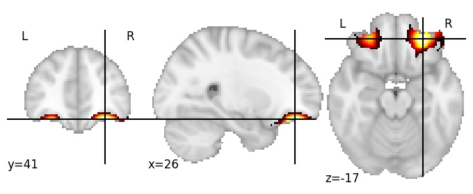 Component 723: Anterior orbital gyrus lateral