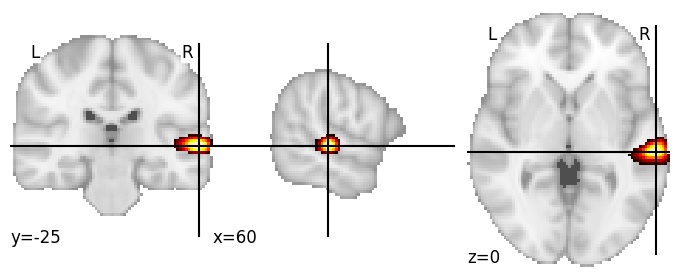 Component 781: Superior temporal gyrus posterior RH