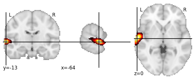 Component 792: Superior temporal gyrus middle LH