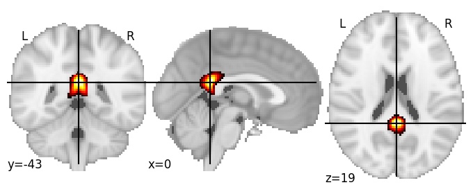 Component 838: Posterior cingulate cortex antero-inferior