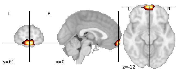 Component 880: Ventromedial prefrontal cortex antero-inferior