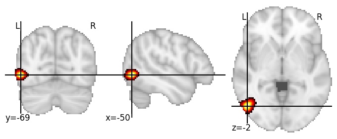 Component 887: Lateral occipital cortex antero-inferior LH