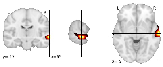 Component 938: Superior temporal gyrus mid-posterior RH