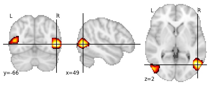 Component 25: Lateral occipital cortex inferior