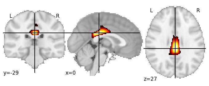 Component 6: Posterior cingulate cortex antero-inferior