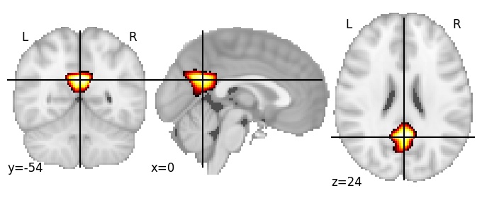 Component 52: Posterior cingulate cortex inferior