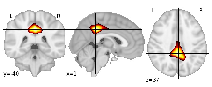 Component 63: Posterior cingulate cortex superior