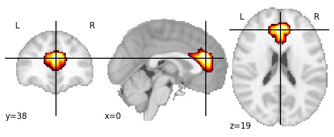 Component 69: Anterior cingulate cortex
