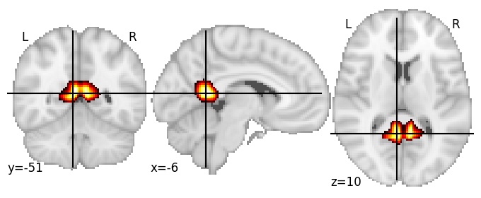 Component 102: Posterior cingulate cortex inferior