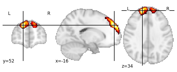 Component 12: Superior frontal gyrus anterior