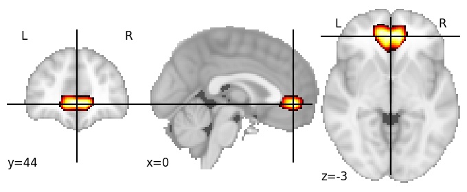 Component 149: Anterior cingulate cortex inferior