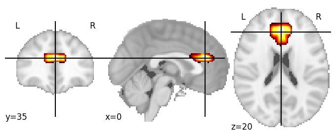 Component 176: Anterior cingulate cortex superior