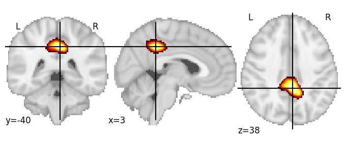 Component 188: Posterior cingulate cortex superior
