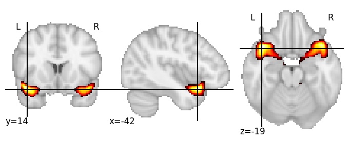 Component 217: Superior temporal gyrus anterior
