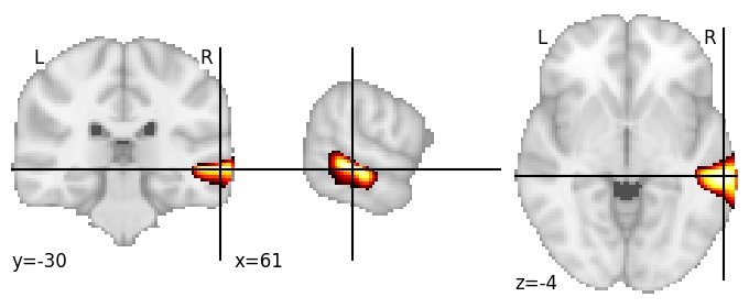 Component 225: Middle temporal gyrus middle RH