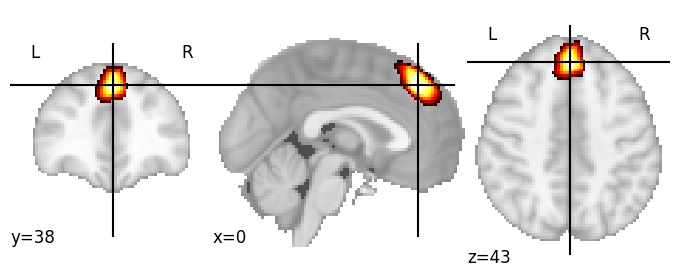 Component 229: Dorsomedial prefrontal cortex posterior