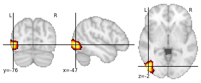 Component 240: Lateral occipital cortex inferior