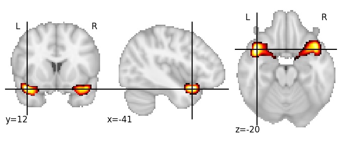 Component 114: Superior temporal gyrus medial anterior