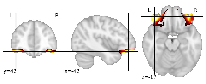 Component 147: Lateral orbital cortex