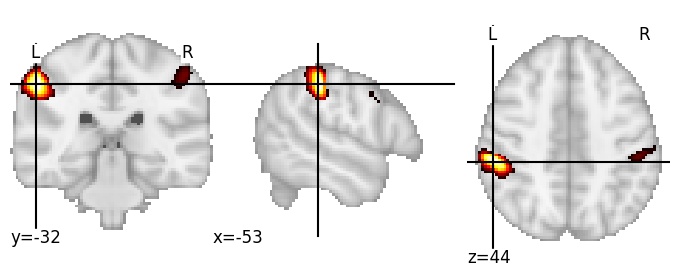 Component 17: Supramarginal gyrus antero-superior LH