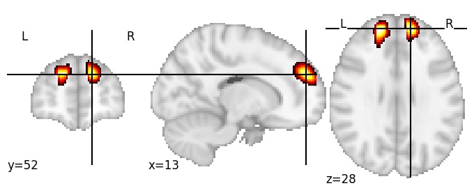 Component 174: Superior frontal gyrus anterior