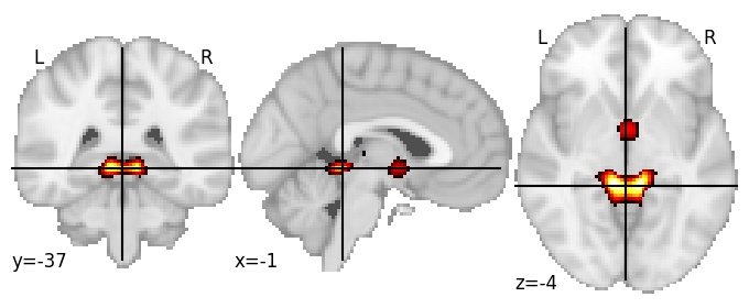 Component 194: Cerebrospinal fluid (between superior cerebellum and limbic lobe)