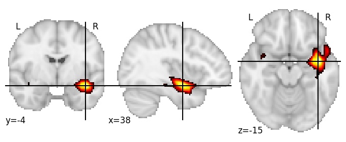 Component 215: Superior temporal gyrus medial anterior RH