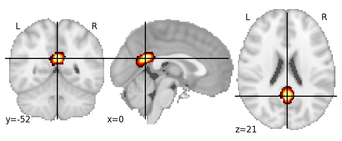 Component 248: Posterior cingulate cortex inferior